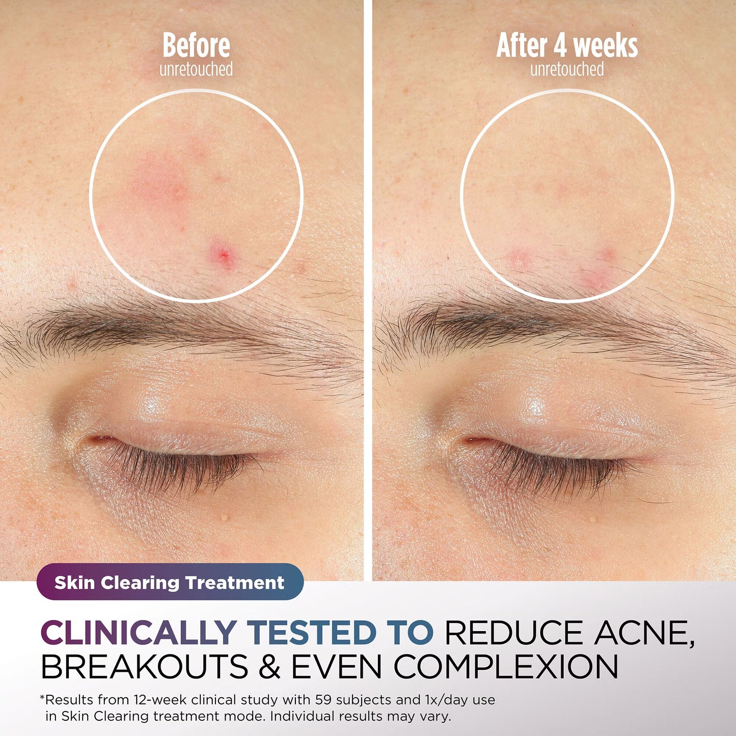 CryoGlow Under-Eye Cooling & LED Anti-Ageing & Blemish Repair Mask